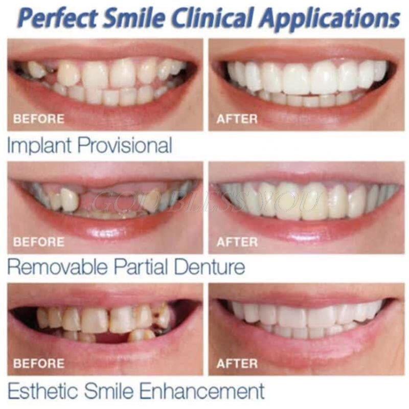 Sorriso Perfeito™️ Dentaduras removíveis (Kit superior + inferior) - Outlet De Todos